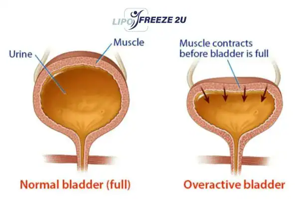 diagram of overactive bladder treatment Stoke