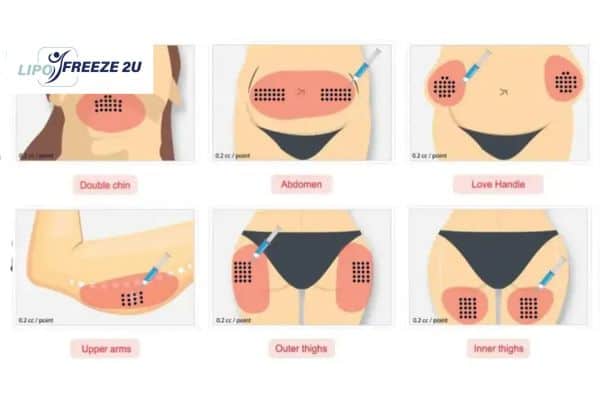 Benefits of Choosing Aqualyx for Fat Reduction Stoke
