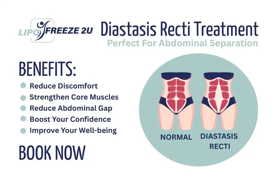 Benefits of body toning treatment Stoke for Diastasis recti