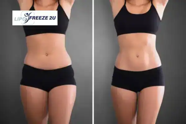 How Can LIPO FREEZE 2U Support Your Post-Pregnancy Body Recovery Stoke?