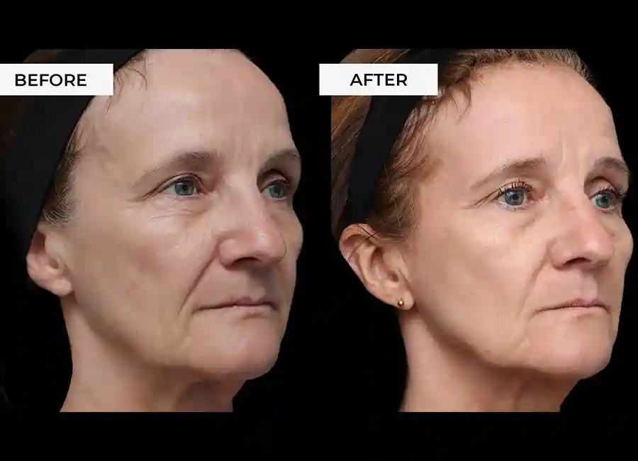 How Many RF Microneedling Sessions Will You Need to See a Difference Stoke?