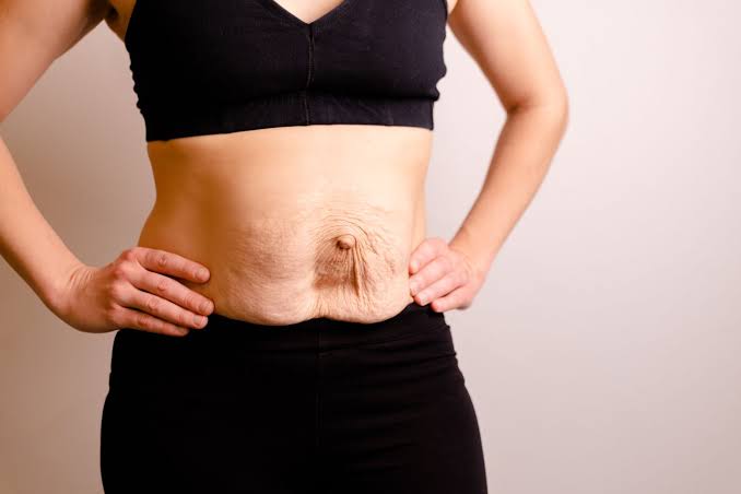 Is Surgery Really the Only Way to Repair Diastasis Recti Stoke?