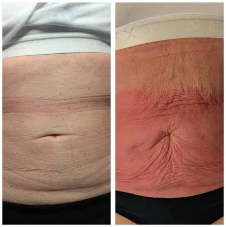 How Does RF Microneedling Improve Crepey, Thin and Uneven Skin Texture Stoke?