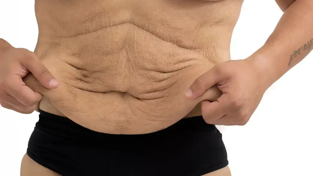 RF Microneedling for Loose Skin: How Can It Help Tighten and Reshape the Skin Stoke?